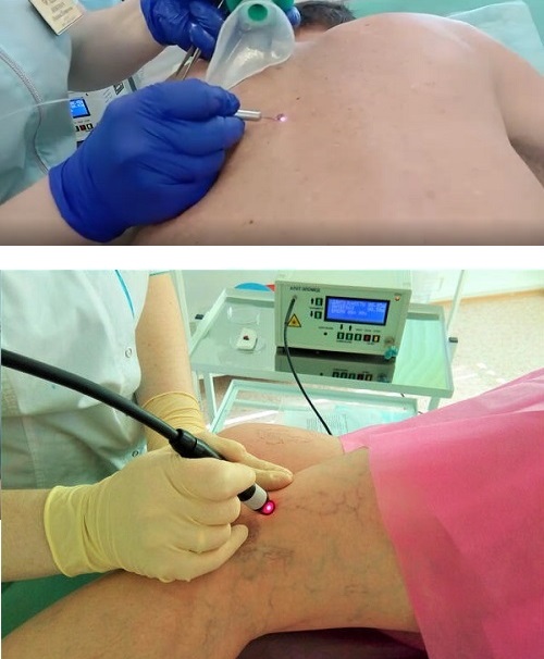 Лазер для общей и амбулаторной хирургии
